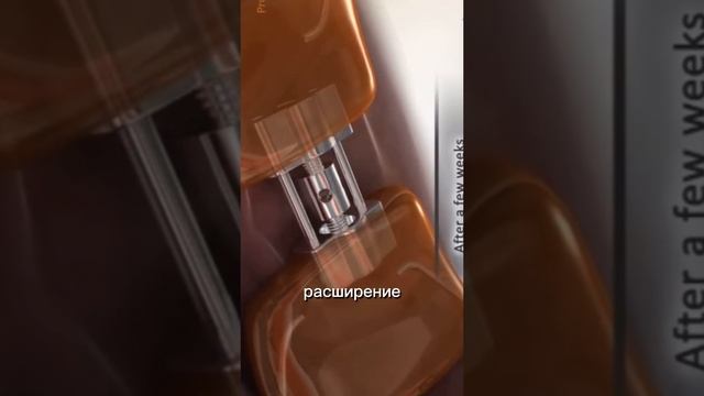 Коррекция прикуса у детей при смене зубов. Аппарат Марко Роса
