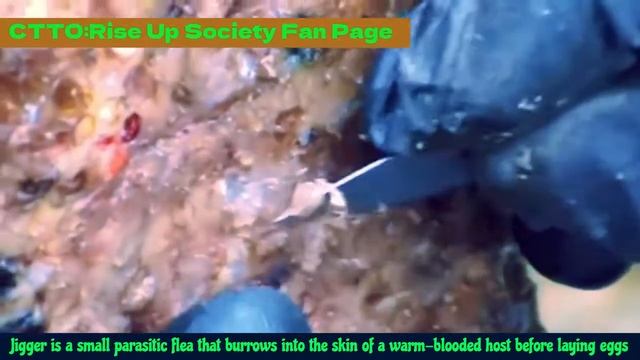 Satisfying Video of Jiggers removal😲😲😲 смотреть онлайн