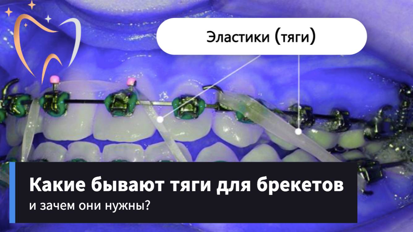 🛠Какие бывают тяги для брекетов и зачем они нужны?