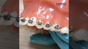 Первая помощь на дому, когда фиксатор-проволока, удерживающий брекет на дуге, колит