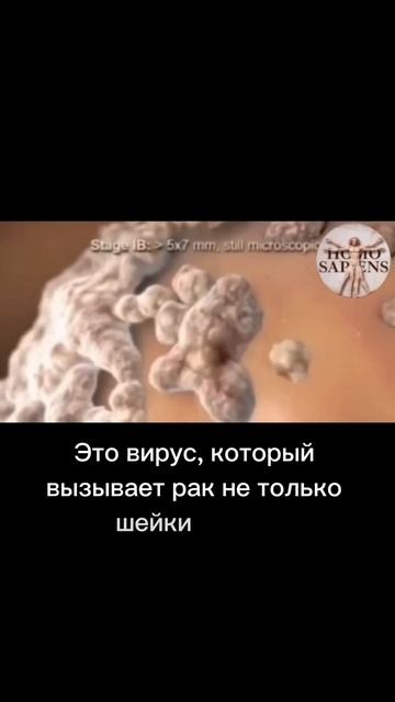 #онкоцитология #ракшейкиматки #гинеколог #впч