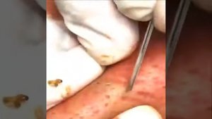 Удаление угрей, удаление угрей, угрей, удаление End