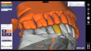 Моделирование в артикуляторе. Modeling in the articulator. Exocad
