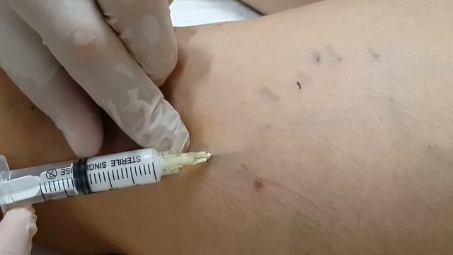 Склеротерапия Sclerotherapy
