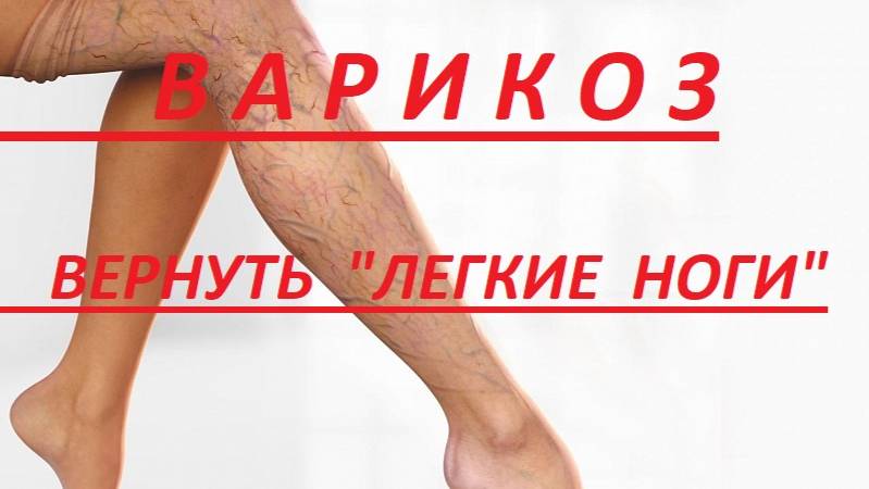 ВАРИКОЗ.  КЛАПАННАЯ  НЕСОСТОЯТЕЛЬНОСТЬ.  ТЯЖЕСТЬ  В  НОГАХ.  ЛЕЧАТ  НЕ  ТОЛЬКО  ТАБЛЕТКИ. смотреть онлайн