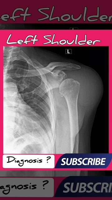 Diagnosis ? X Ray Left shoulder - Practical case - Radiology смотреть онлайн