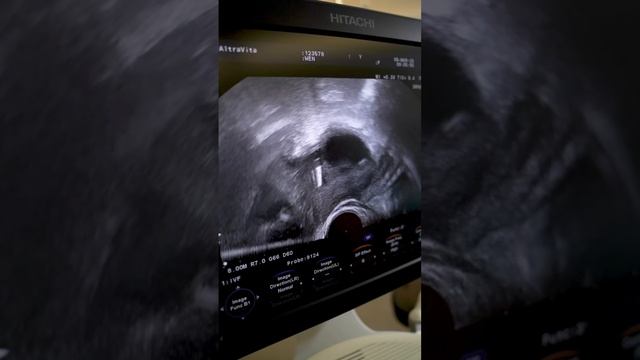 Пациентка 37 лет с вторичным бесплодием — сколько яйцеклеток мы получим? 🧐