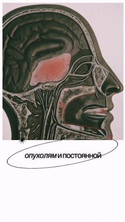 Опасность капель для носа: как привычка приводит к инсульту в 30 лет! #инсульт #капливнос #здоровье