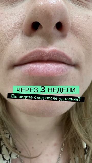 Удаление родинок БЕЗ СЛЕДА  реальнобородавки лазерноеудаление папилломы удалениеродинки