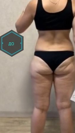 KRIOLIPOLIZ_NOG