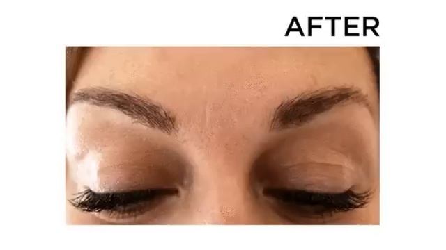 Anti-Wrinkle Treatment in Therapie Clinic UK