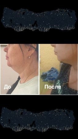 Kriolipoliz_podborodka