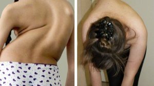 Сколиоз-Документальный фильм