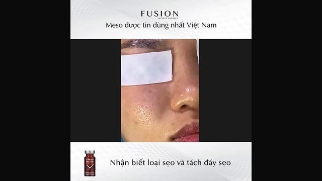 Liệu trình điều trị sẹo với Fusion Meso Matrix