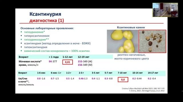 Ксантинурия - редкая причина уролитиаза у детей