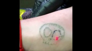 Лазерное удаление тату в Брянске