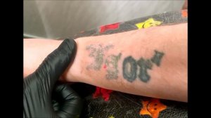 Удаление татуировки в Брянске