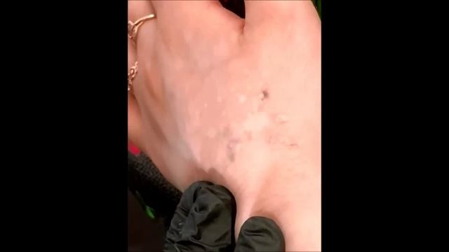Удаление тату лазером в Брянске