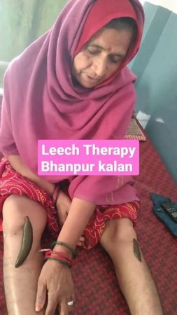 Leech Therapy Bhanpur kalan