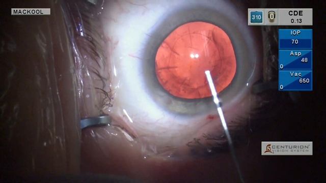 Episode 58: Surgical and IOL Considerations in the Post RK Eye смотреть онлайн