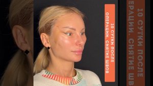 Эндоскопическая подтяжка лба