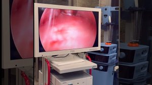 Эндоскопическая подтяжка лица