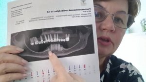 А вот теперь про имплантацию челюсти. Операция под наркозом 5 часов.