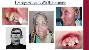 Cours Magistral 1 - L'Inflammation - La physiologie pathologique