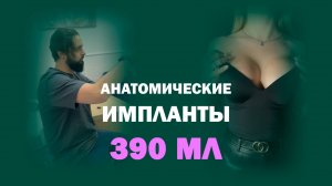 Увеличение груди 390 мл: от разметки до года реабилитации