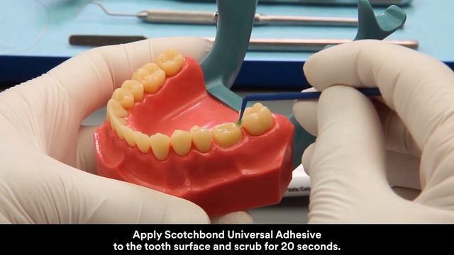 3M RelyX Ultimate automix cementation glass ceramic tack cure смотреть онлайн