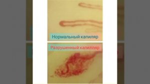 Капиляроскопия