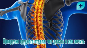 Протрузия грудного отдела: что делать и как лечить