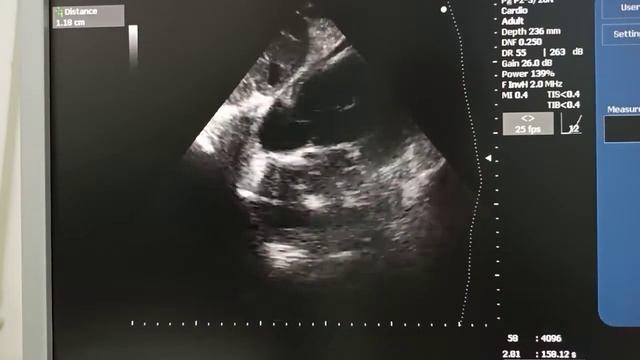 Эндокардит легочного клапана из субкостального доступа
