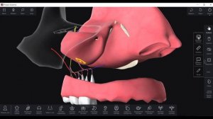 Перфорация верхнечелюстной пазухи