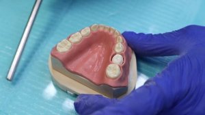 детские циркониевые коронки установка