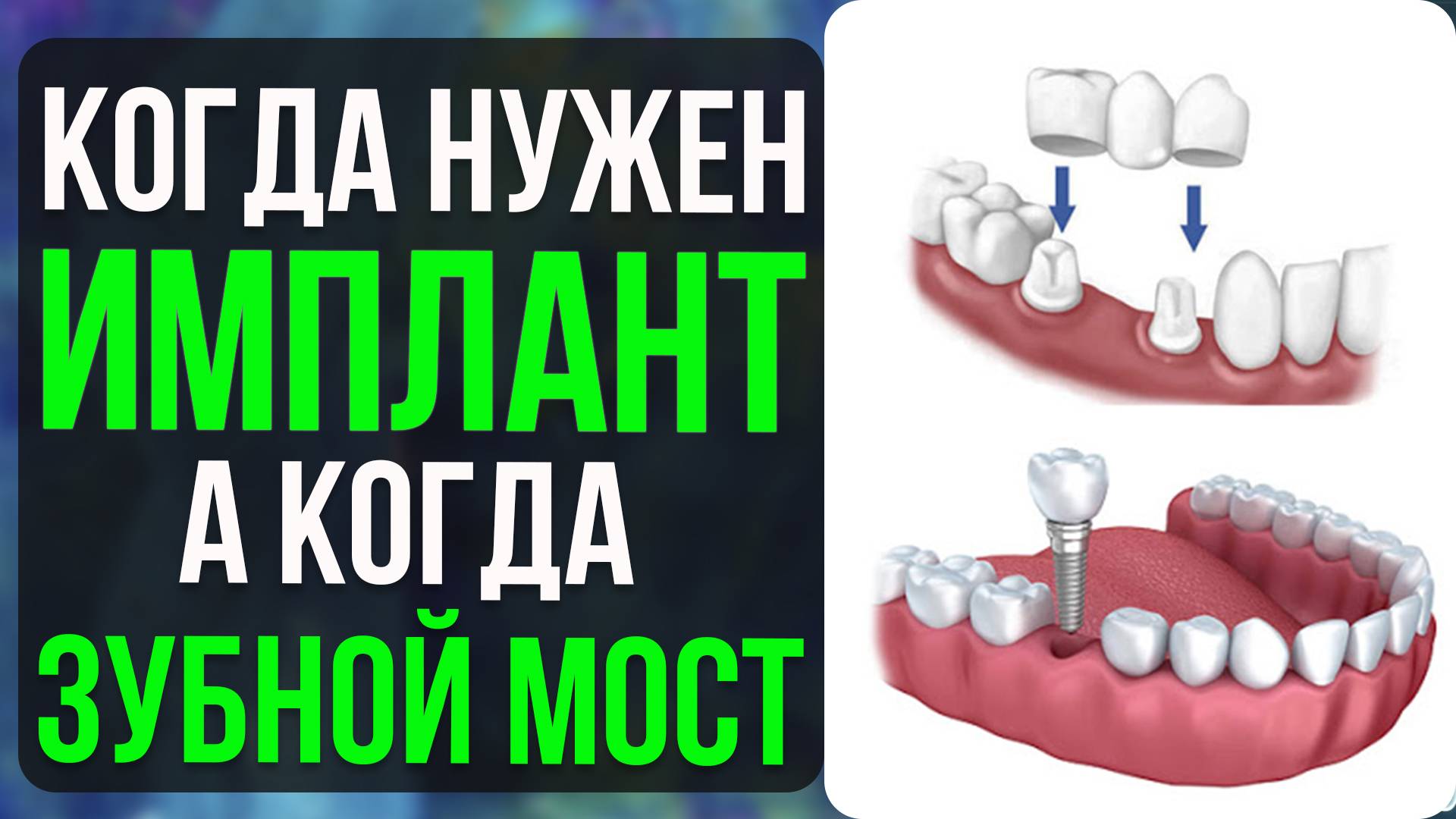 Имплант или Зубной Мост? Стоматолог советует в каких случаях что лучше выбрать!