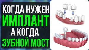 Имплант или Зубной Мост? Стоматолог советует в каких случаях что лучше выбрать!
