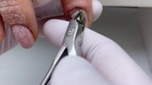 Гематома под ногтем/прищемила палец/вскрытие ногтя