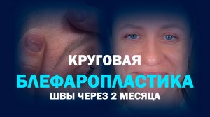 Классическая блефаропластика: 2 месяца спустя – где рубцы?
