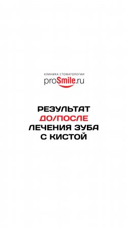 Лечение зуба с радикулярной кистой. Работа Шукевич С.Е.