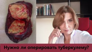 Нужно ли оперировать туберкулему