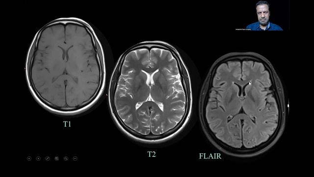 How to Read Normal Head MRI