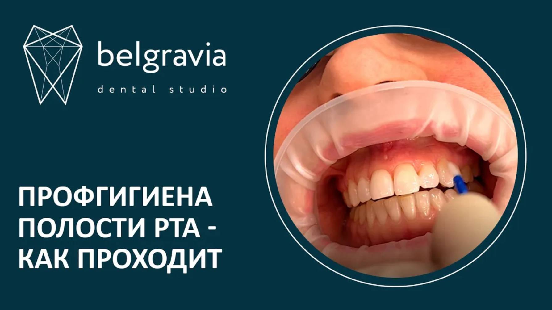 😬 Профгигиена полости рта - как проходит