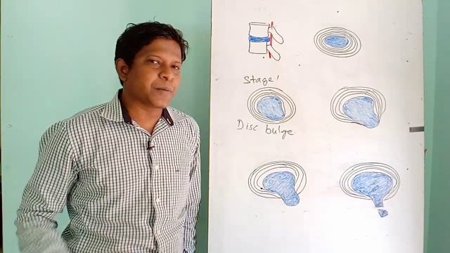 डिस्क प्रॉब्लम क्या होती है? Is Disc Bulge Completely Curable?