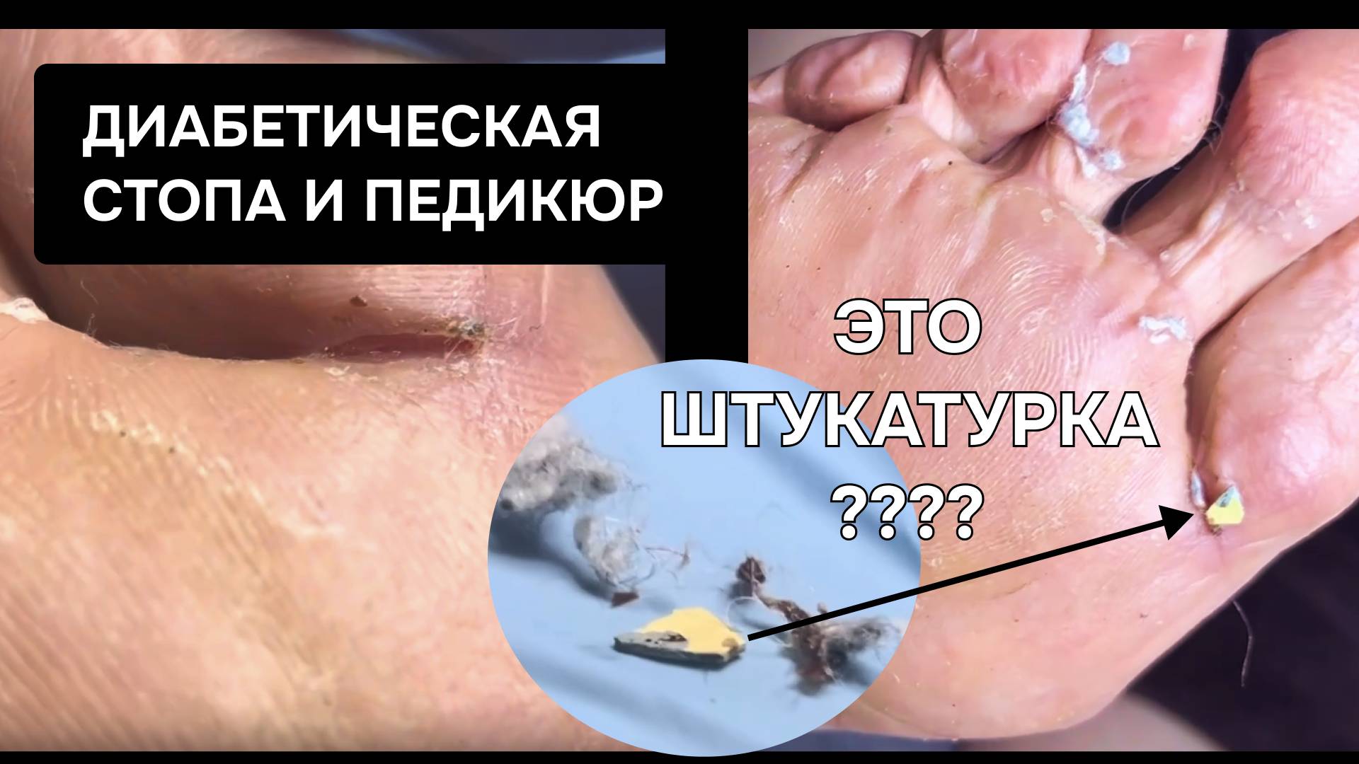 Клиент подолога с ОСКОЛКОМ в ноге?!  Полинейропатия//Синдром диабетической стопы // подология