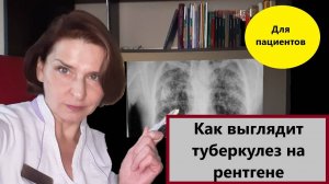 Рентген туберкулеза