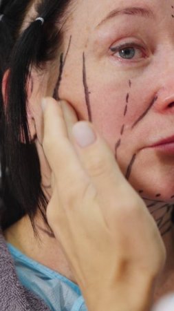 Омоложение нижней трети лица и шеи. 
Хирург: Головатая Ирина Вячеславовна