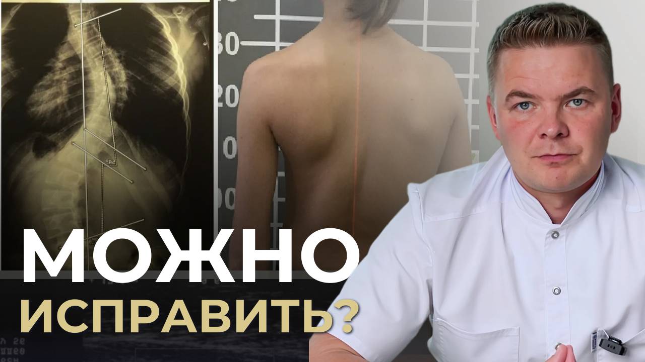 Нужно ли исправлять искривление у взрослых и можно ли это сделать?