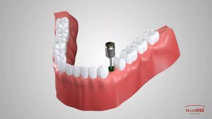 Single Crown Restoration With T6 Standart Abutment