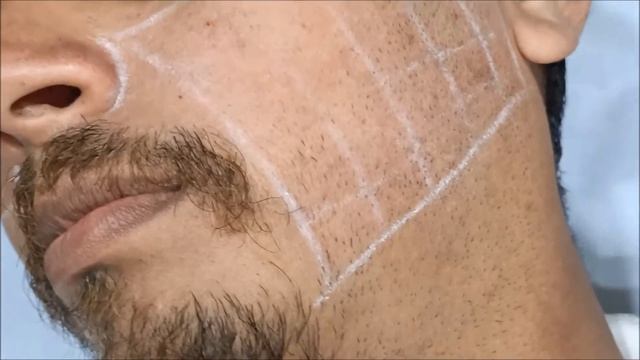 Filler For Anti Aging Treatment, Wrinkle Correction, Younger Looking Skin Surat, Vapi,Gujarat, Pune